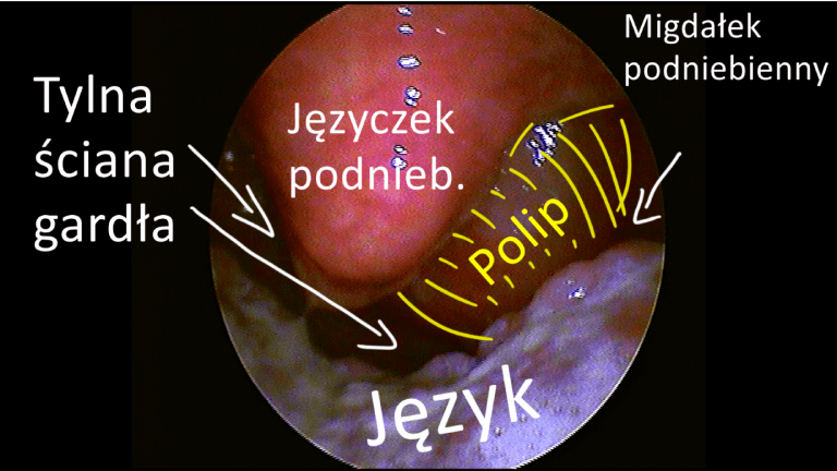 Polipy nosa i zatok z polipem choanalnym