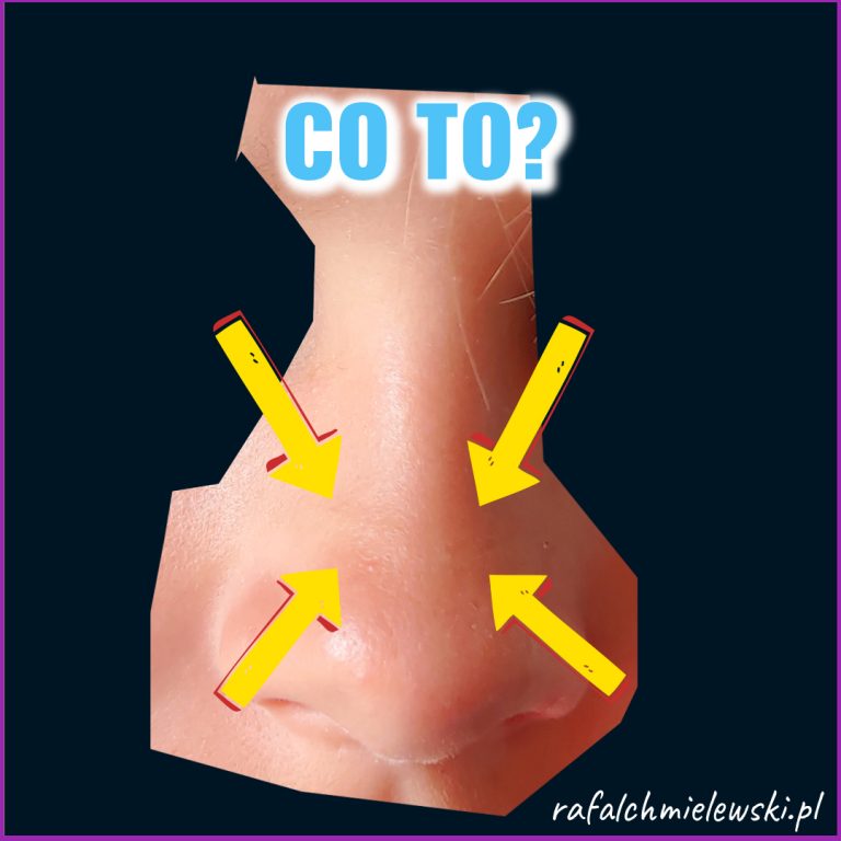 Bruzda alergiczna — skutek powtarzanego salutu alergicznego