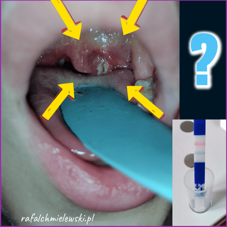 Angina — paciorkowcowe (ropne) zapalenie migdałków podniebiennych