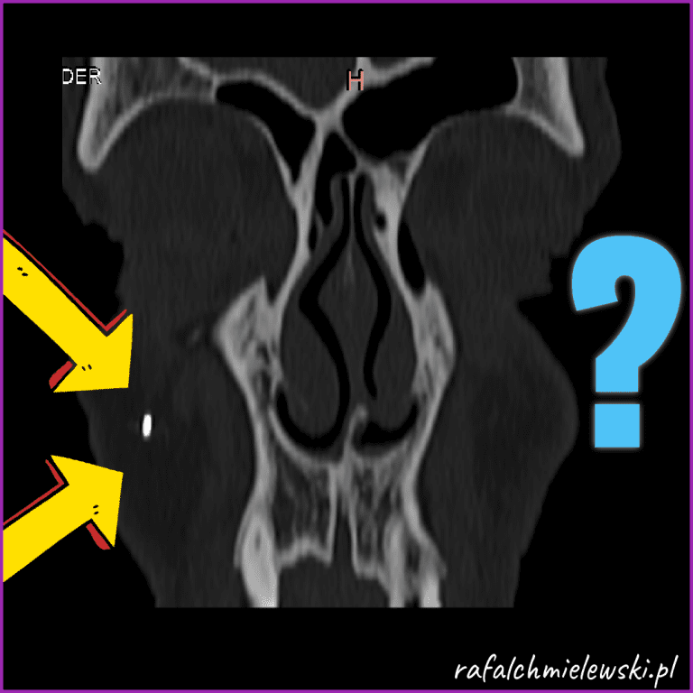Ciało obce policzka