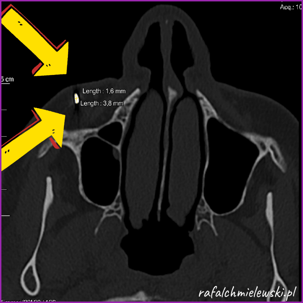 TK zatok - mataliczne ciało obce policzka